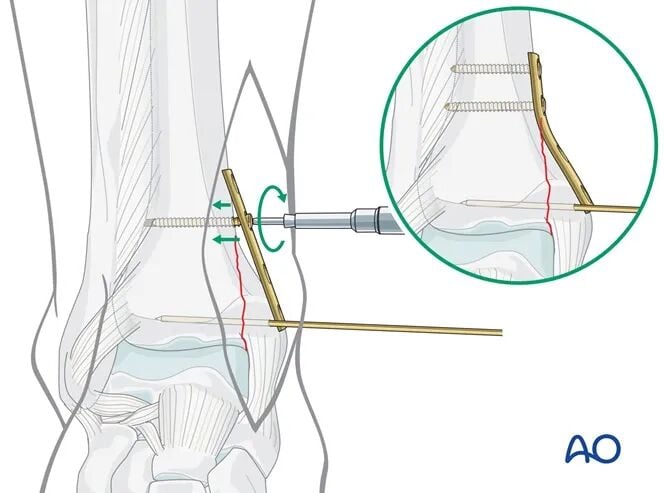 AO Standard Technique: Buttress Plate Fixation for Medial Malleolus Fractures