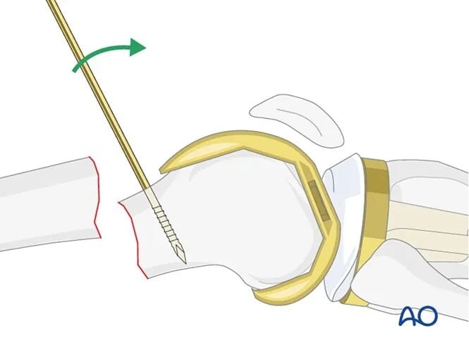 Retrograde Intramedullary Nailing for Periprosthetic Femoral Fractures After TKA: AO Standardized Surgical Strategy – Illustrated Step-by-Step Guide