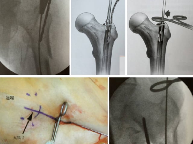 How to Correctly Create the Entry Point During Surgery for Intertrochanteric Fractures