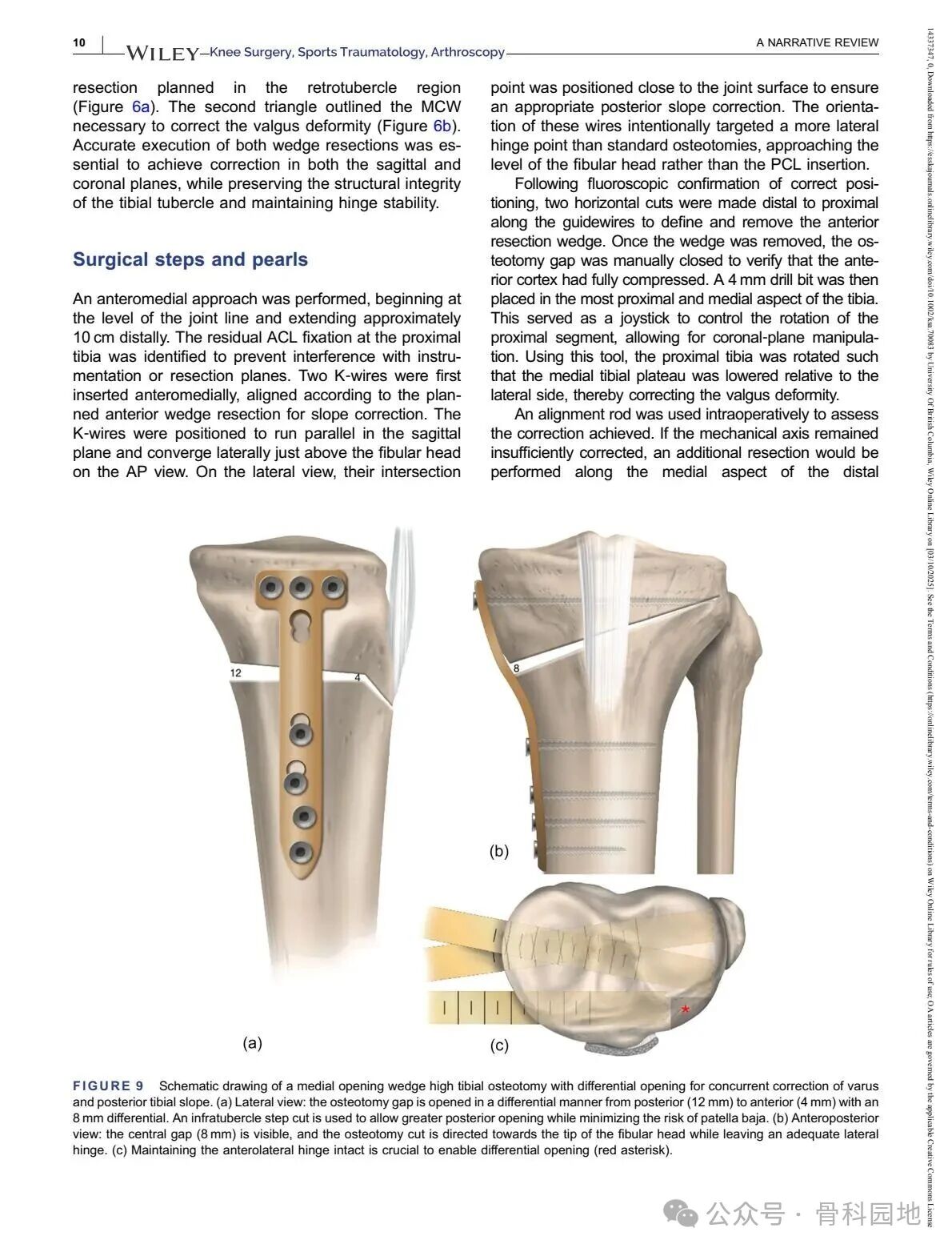 Technical Tips and Tricks for Complex Biplanar High Tibial Osteotomy