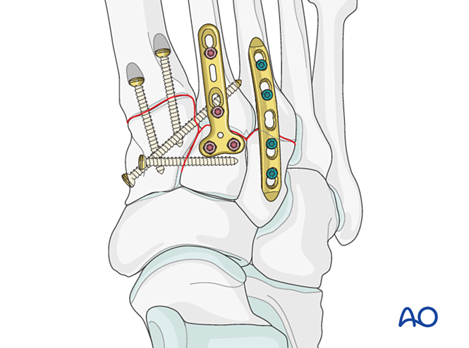 IV. Approach Preparation