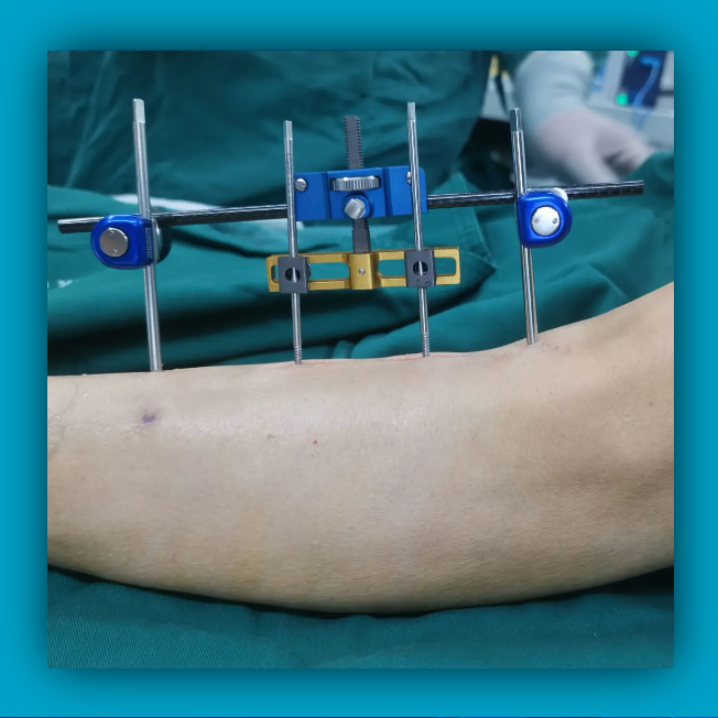 Lateral Tibial Bone Transfer Surgery