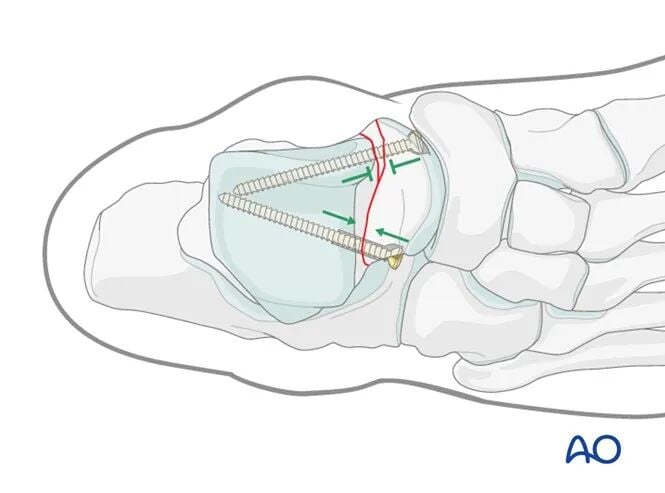 AO Standard Surgery: Screw Fixation for Displaced Talar Neck Fractures