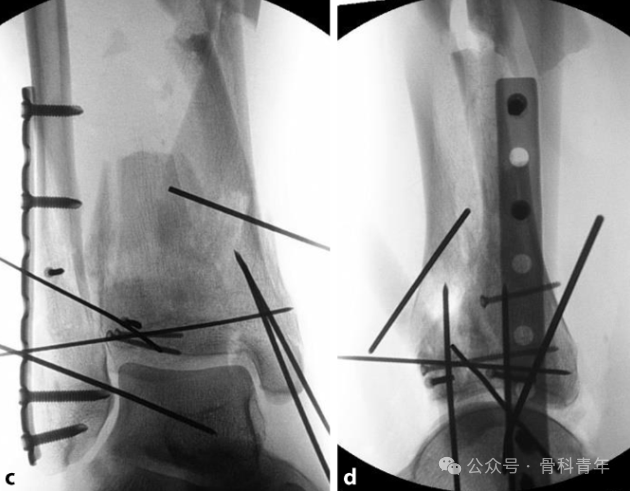 Complex Pilon Fractures: The "Four Principles" and the "Four-Step Foundation Method"