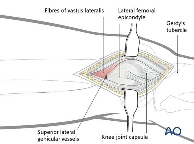 Minimally Invasive Lateral/Anterolateral MIPO Approach to the Distal Femur