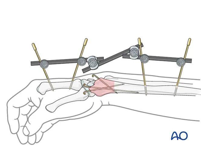 Transarticular External Fixation for Distal Radius Fractures