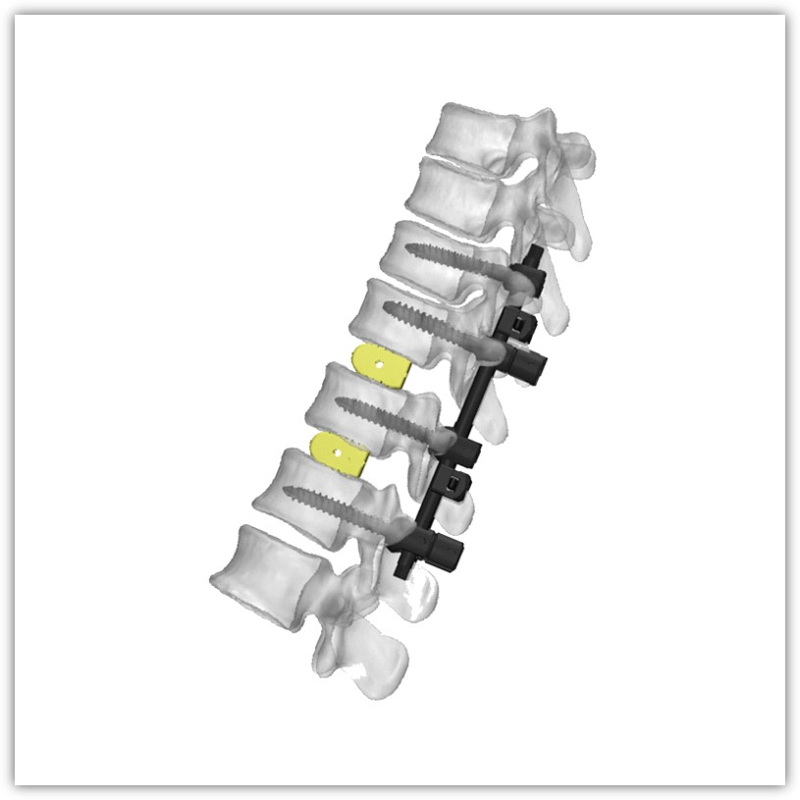 https://shopcdnalpha.grainajz.com/category/83036/2966/0fbf9e0eb83f77190ff3c13a761f0d5a/Spinal%20System.jpg