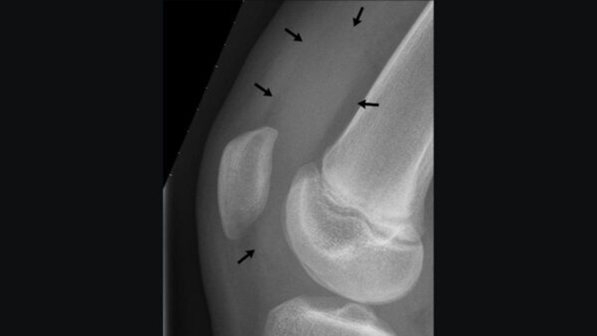 X-ray interpretation (ABCS approach)