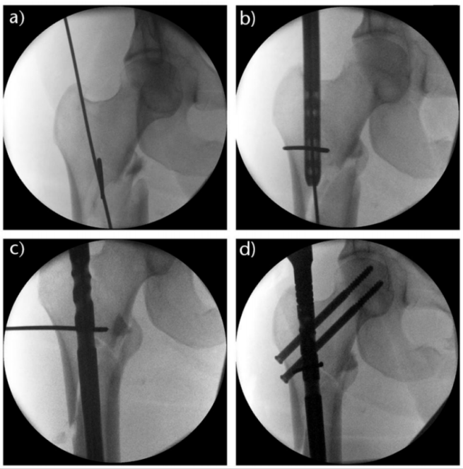 Subtrochanteric Femur Fractures: Anatomy, Classification, and Treatment Options