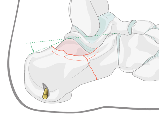 Minimally Invasive K‑Wire and Screw Fixation for Calcaneal Fractures