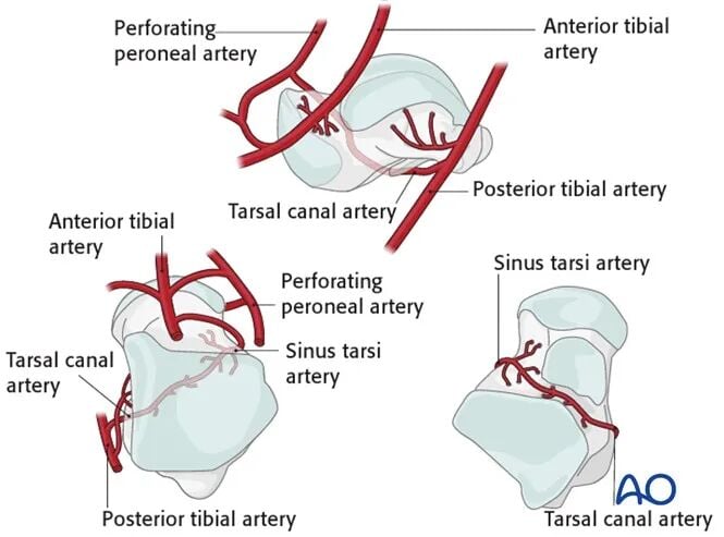 AO Standard Surgery: Screw Fixation for Displaced Talar Neck Fractures