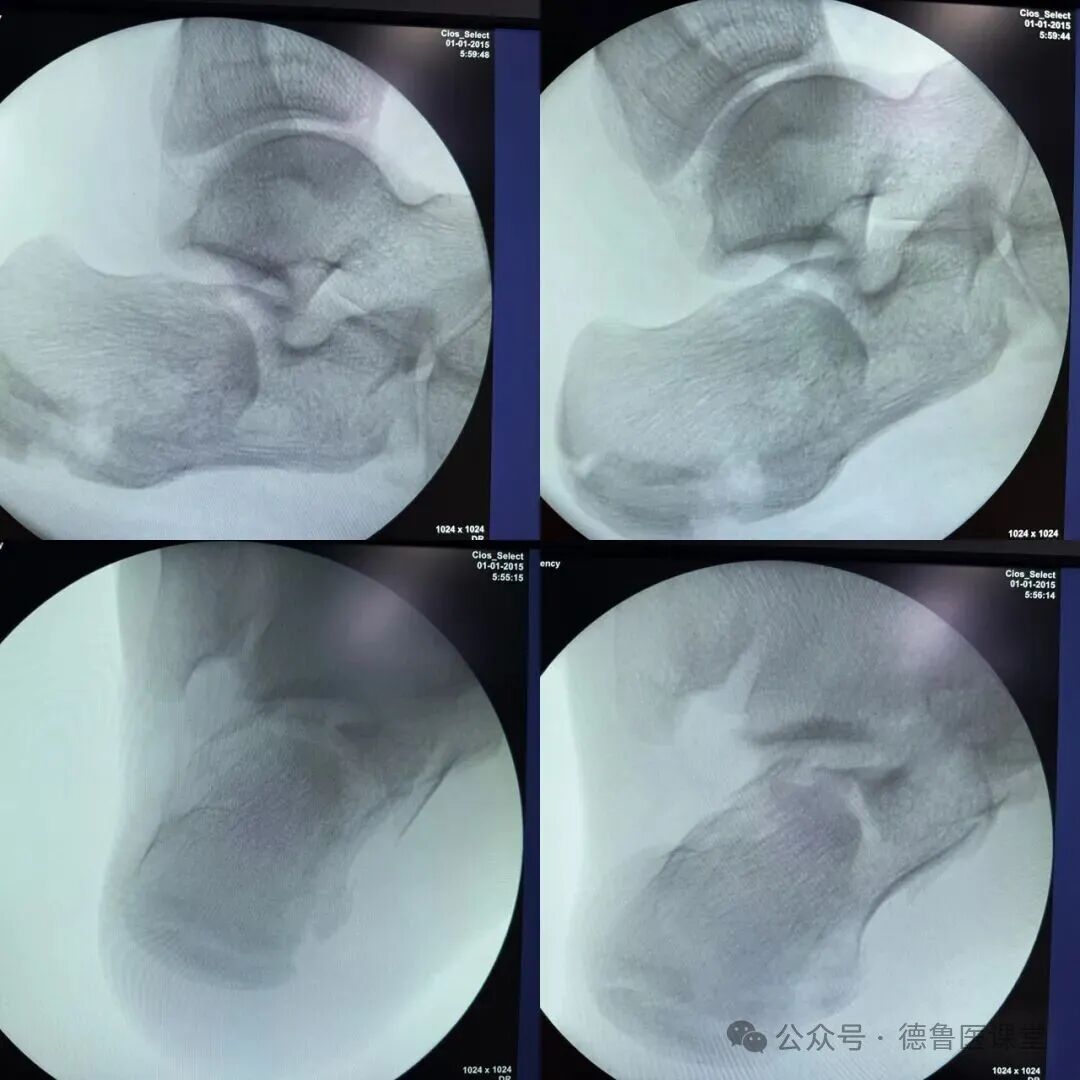 How to Perform a Successful Minimally Invasive Calcaneal Surgery