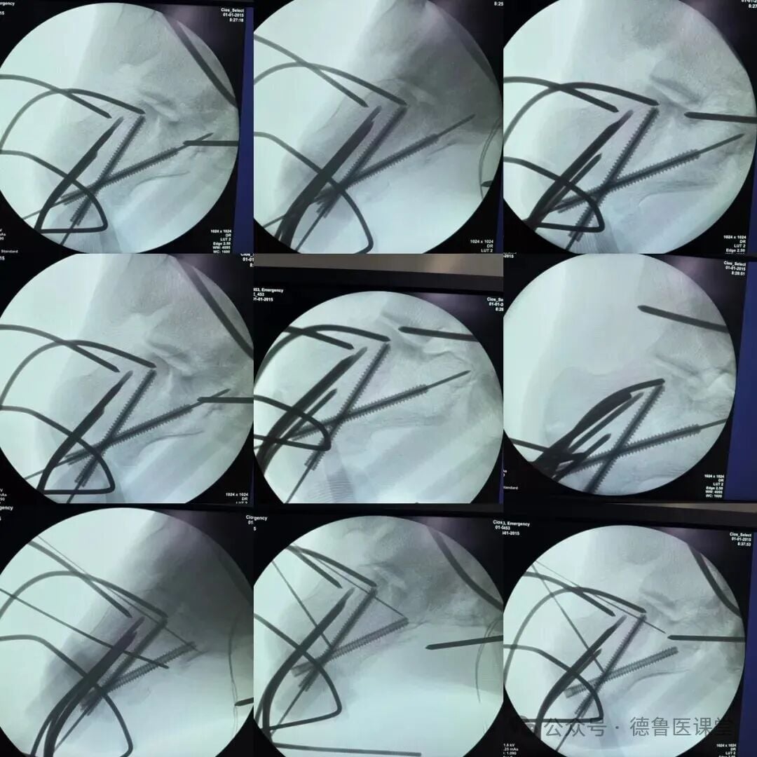 How to Perform a Successful Minimally Invasive Calcaneal Surgery