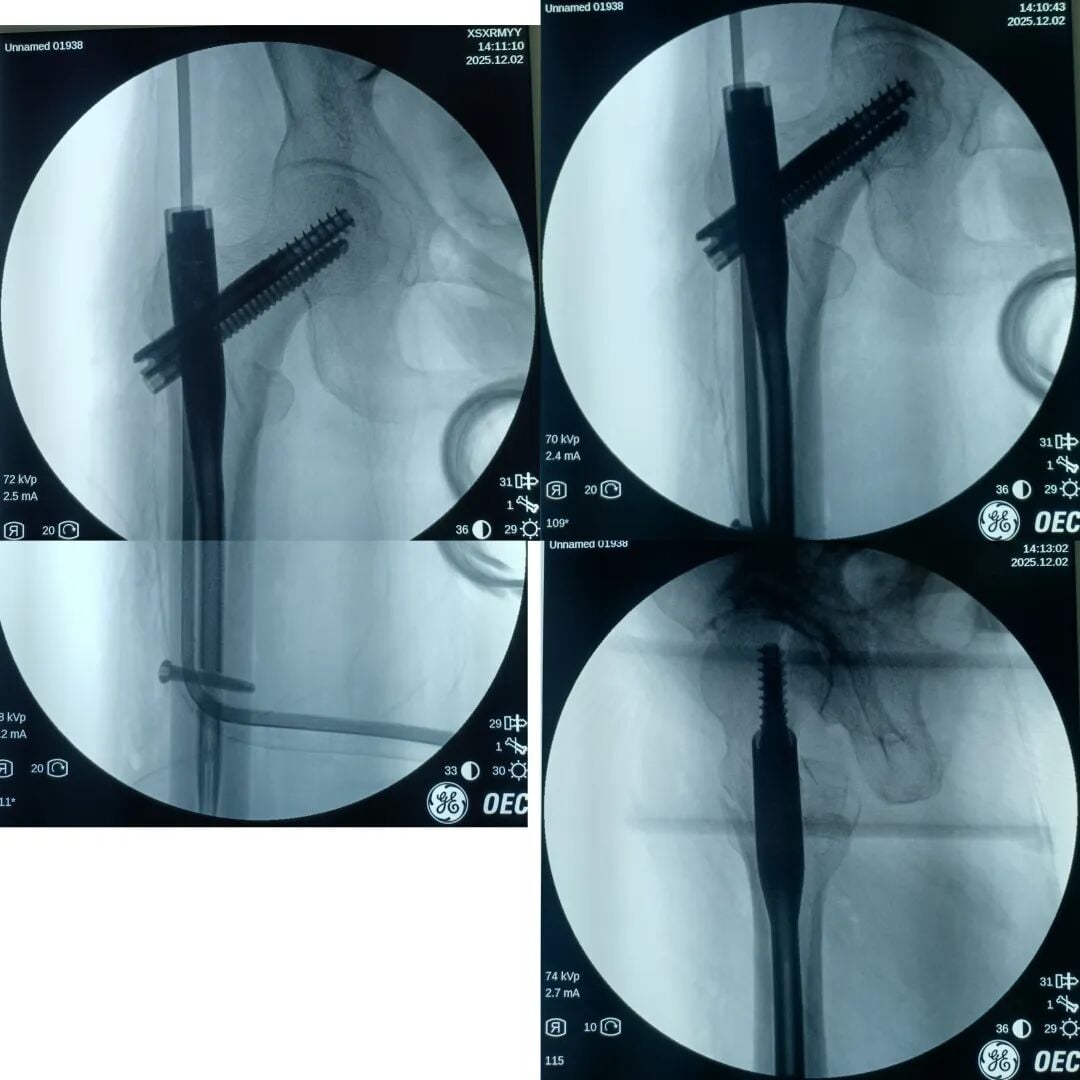 The "Gold Standard Procedure" in Orthopedics: Intramedullary Nailing for Intertrochanteric Fractures – Precise Reduction + Fast Recovery