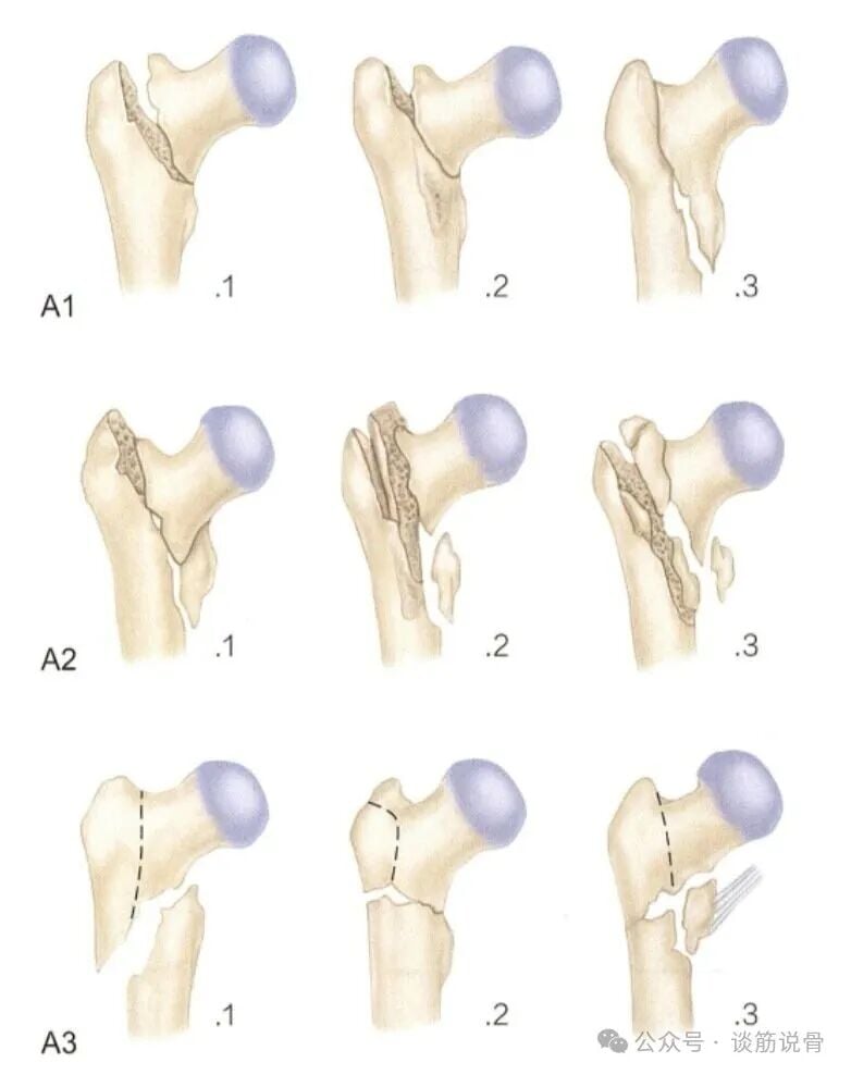 Clinical Decision-Making Between Long and Short Intramedullary Nails for Intertrochanteric Femoral Fractures