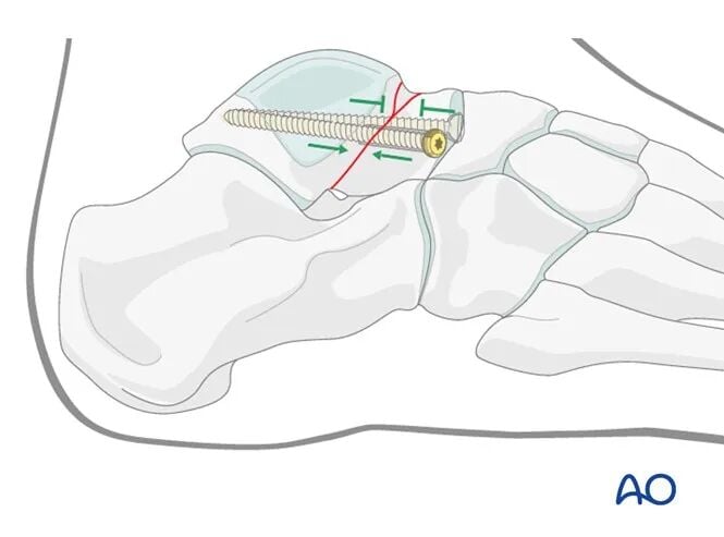 AO Standard Surgery: Screw Fixation for Displaced Talar Neck Fractures