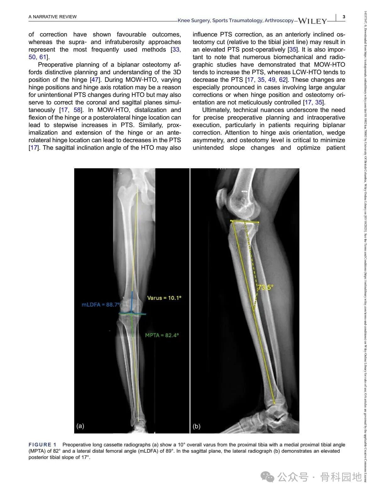 Technical Tips and Tricks for Complex Biplanar High Tibial Osteotomy