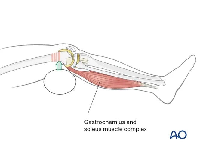 Retrograde Intramedullary Nailing for Periprosthetic Femoral Fractures After TKA: AO Standardized Surgical Strategy – Illustrated Step-by-Step Guide