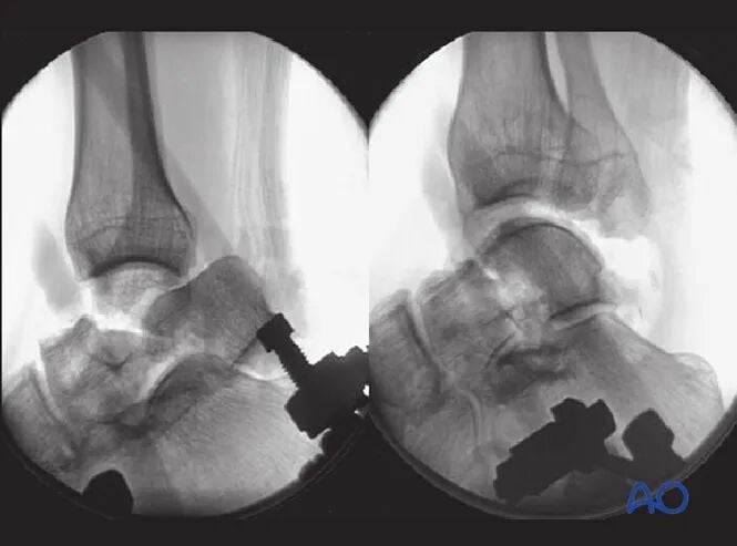 AO Standard Surgery: Screw Fixation for Displaced Talar Neck Fractures