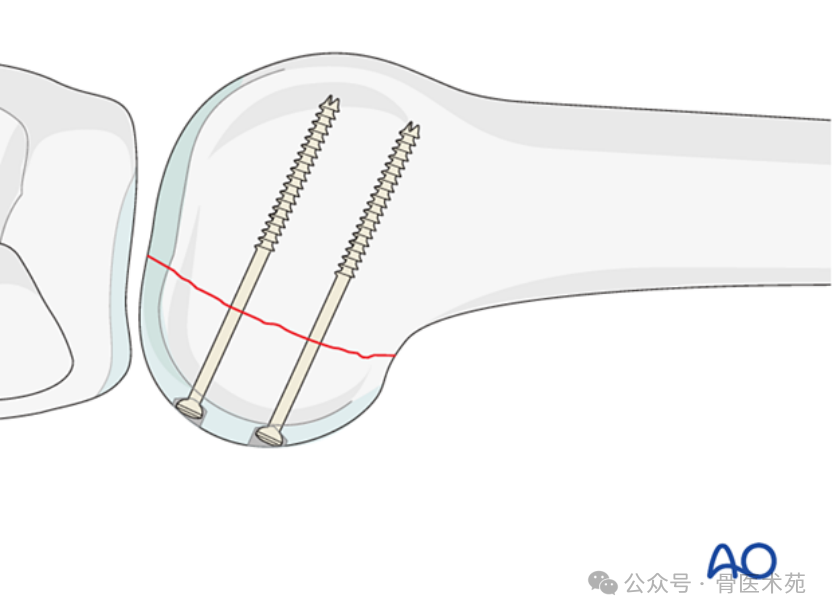 Open Reduction and Internal Fixation of Hoffa Fracture with Plate and Screws