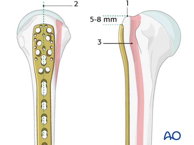 Caution: These Are the Pitfalls in Internal Fixation Surgery for Proximal Humeral Fractures