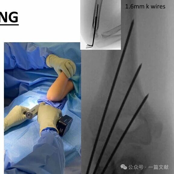Treatment of Pediatric Supracondylar Humerus Fractures