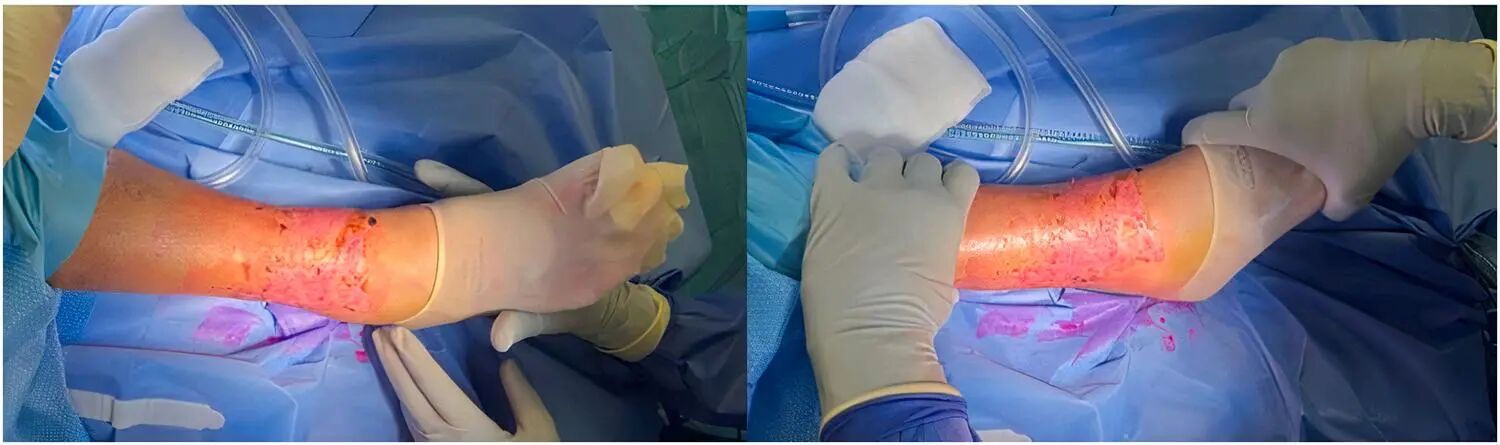 Innovative approach to intramedullary nailing of the fibula: atechnical note