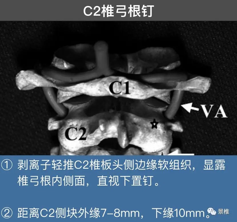 Pedicle Screw Placement Techniques for the Cervical, Thoracic, and Lumbar Spine