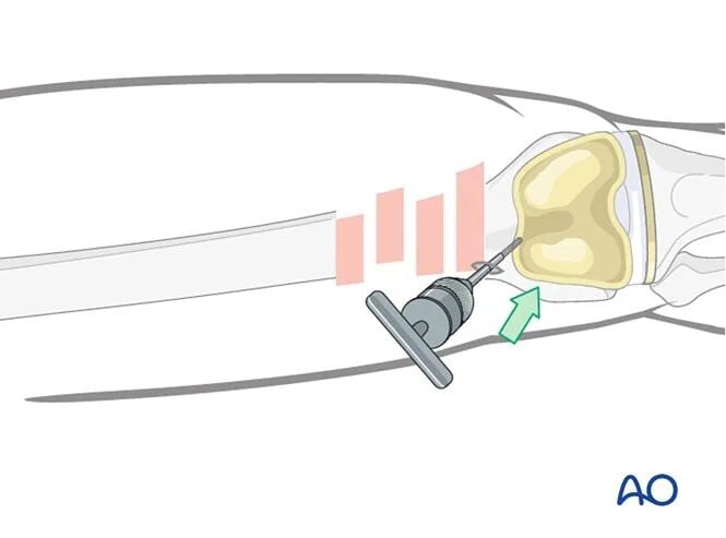 Retrograde Intramedullary Nailing for Periprosthetic Femoral Fractures After TKA: AO Standardized Surgical Strategy – Illustrated Step-by-Step Guide
