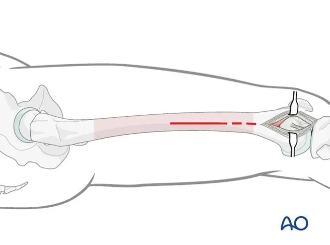Minimally Invasive Lateral/Anterolateral MIPO Approach to the Distal Femur