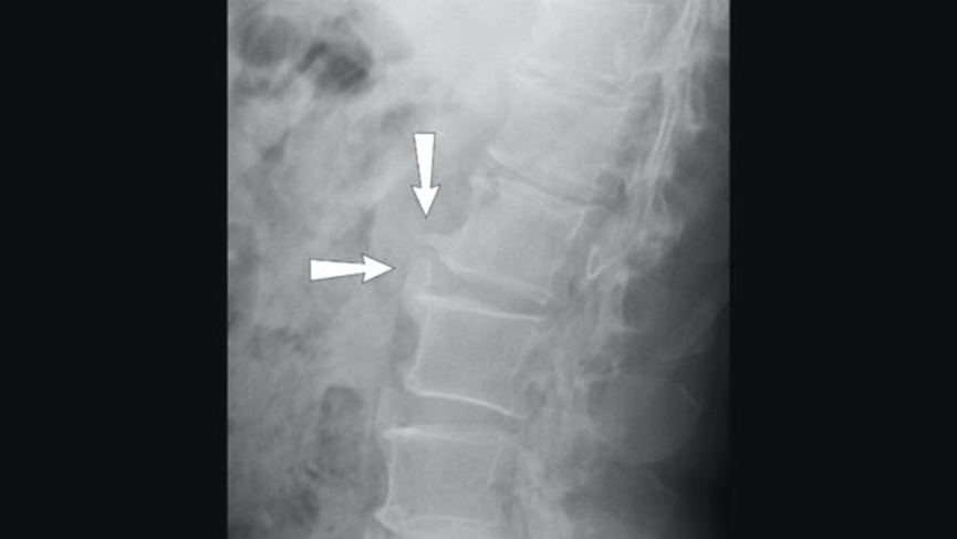 X-ray interpretation (ABCS approach)