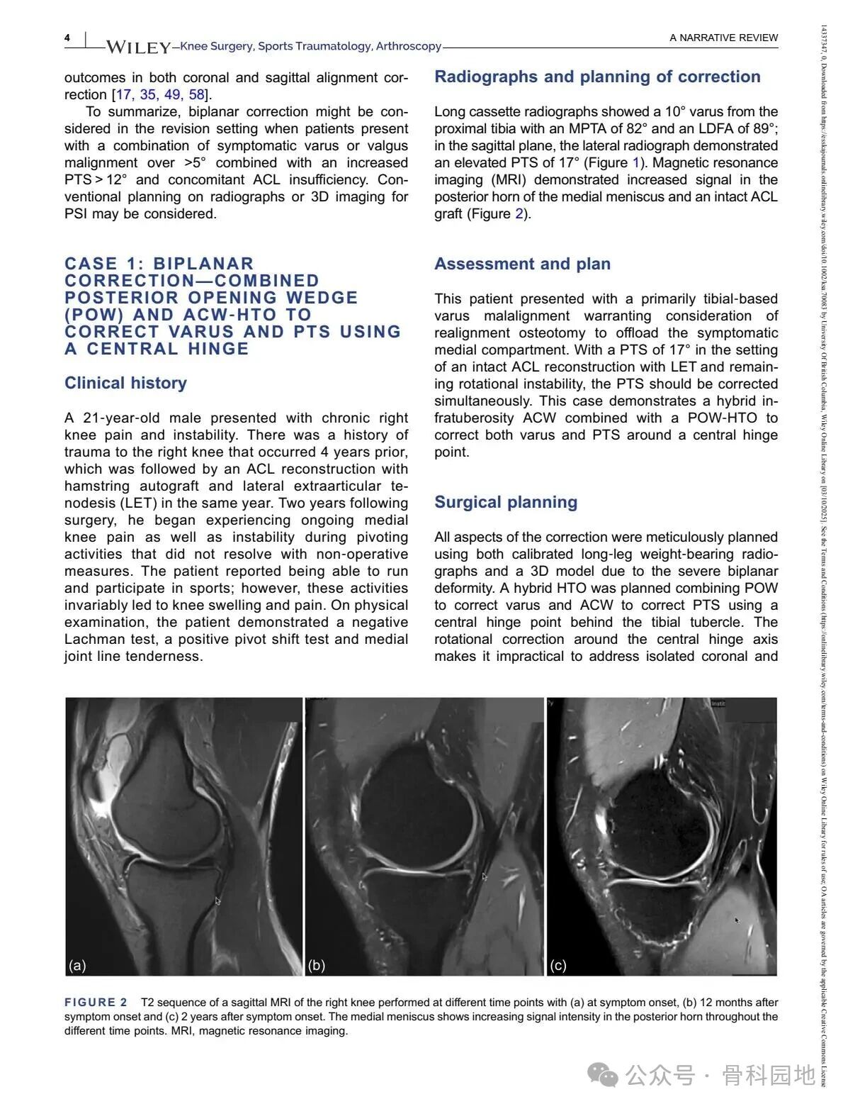 Technical Tips and Tricks for Complex Biplanar High Tibial Osteotomy