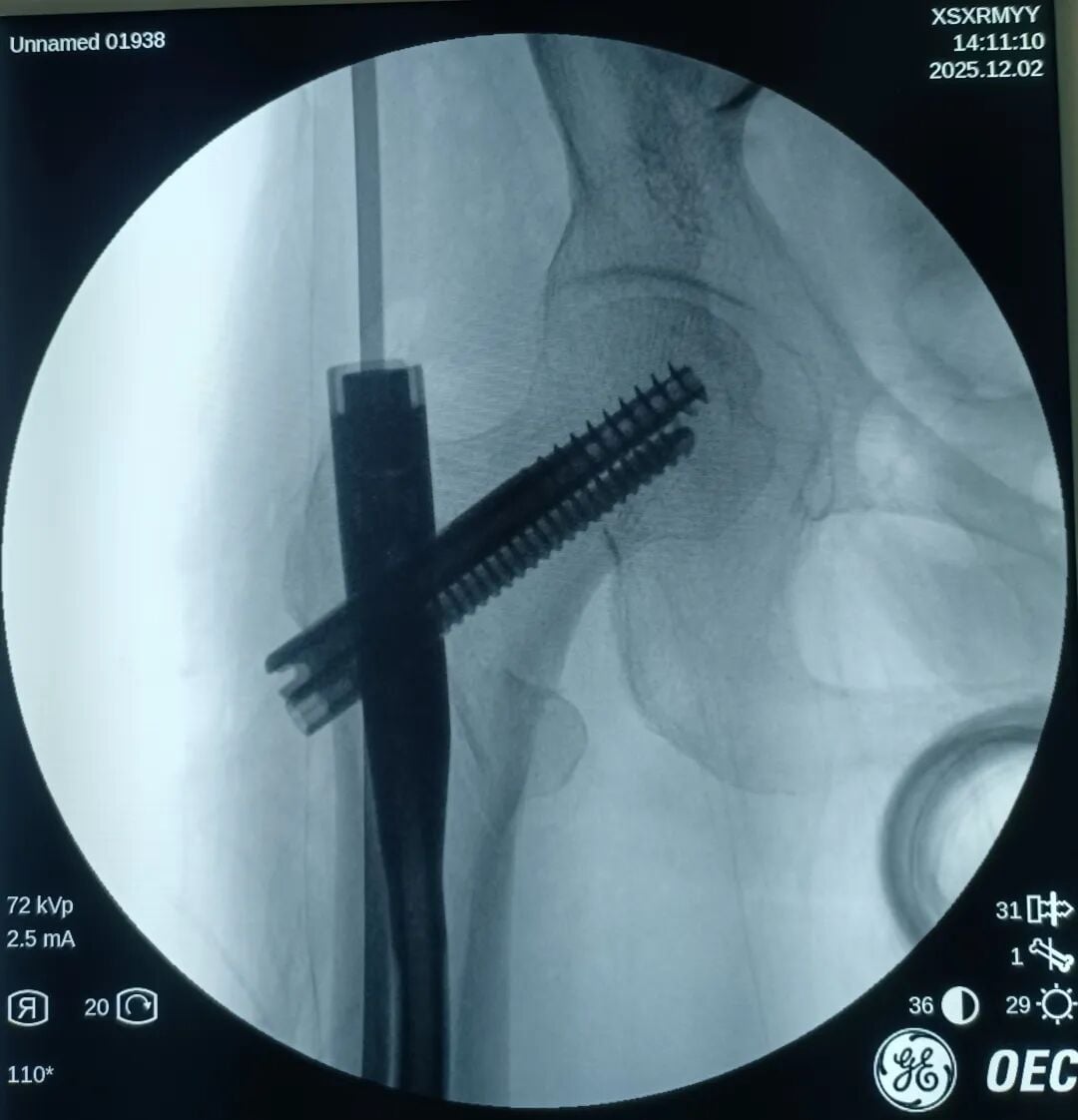 The "Gold Standard Procedure" in Orthopedics: Intramedullary Nailing for Intertrochanteric Fractures – Precise Reduction + Fast Recovery