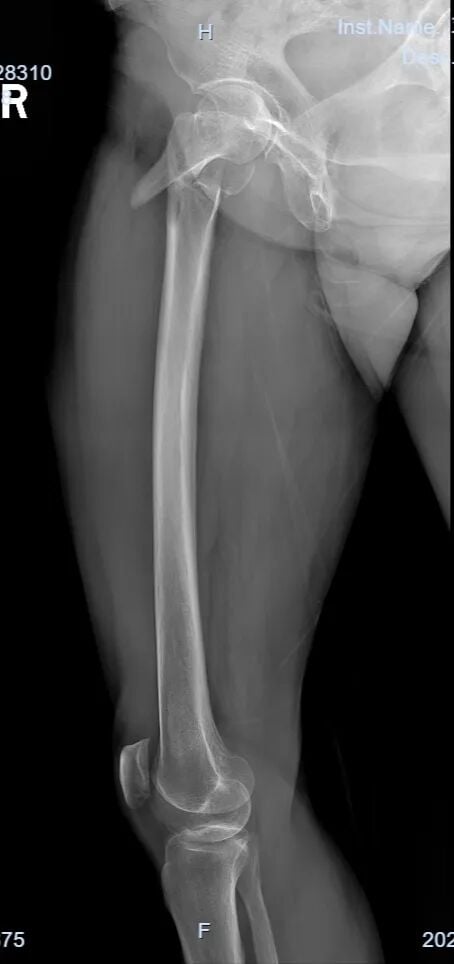 The "Gold Standard Procedure" in Orthopedics: Intramedullary Nailing for Intertrochanteric Fractures – Precise Reduction + Fast Recovery