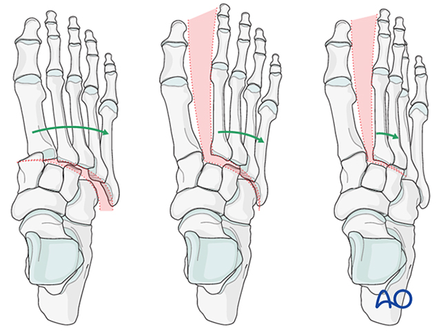 Lisfranc Injury Surgical Illustration, AO Standard!