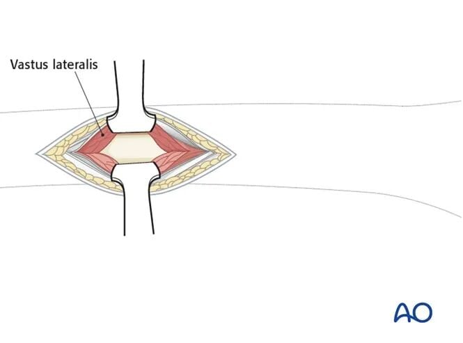 Minimally Invasive Lateral/Anterolateral MIPO Approach to the Distal Femur