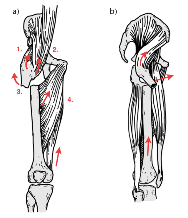 Subtrochanteric Femur Fractures: Anatomy, Classification, and Treatment Options