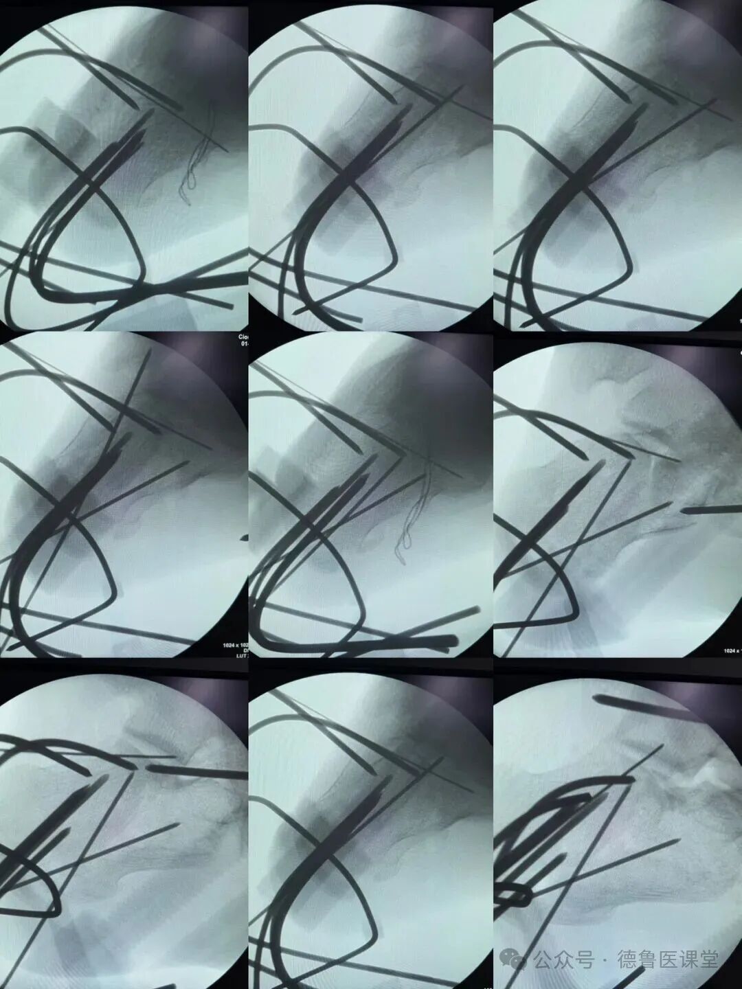 How to Perform a Successful Minimally Invasive Calcaneal Surgery