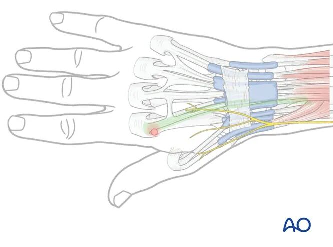 Transarticular External Fixation for Distal Radius Fractures