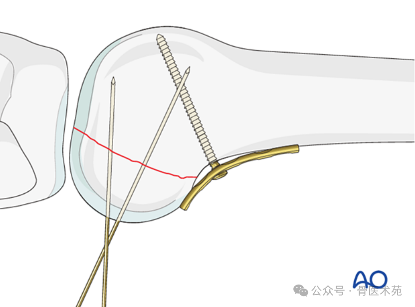 Open Reduction and Internal Fixation of Hoffa Fracture with Plate and Screws