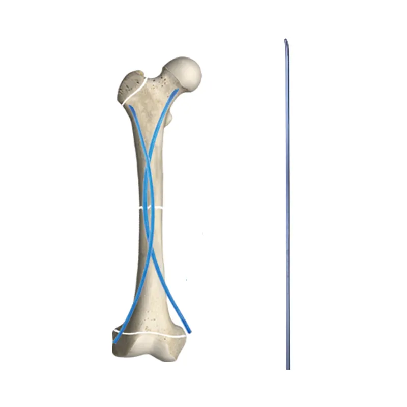 Evolutionary Theory of Intramedullary Nail Technology: Breakthrough from Backbone Fracture to Joint End Fixation