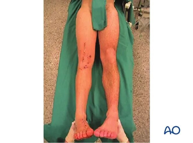 Retrograde Intramedullary Nailing for Periprosthetic Femoral Fractures After TKA: AO Standardized Surgical Strategy – Illustrated Step-by-Step Guide