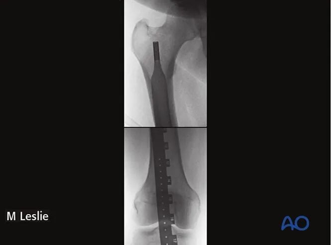 Retrograde Intramedullary Nailing for Periprosthetic Femoral Fractures After TKA: AO Standardized Surgical Strategy – Illustrated Step-by-Step Guide