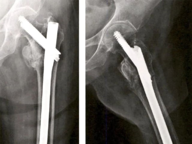 Clinical Decision-Making Between Long and Short Intramedullary Nails for Intertrochanteric Femoral Fractures