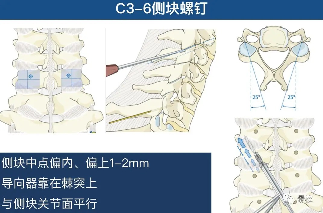 Pedicle Screw Placement Techniques for the Cervical, Thoracic, and Lumbar Spine
