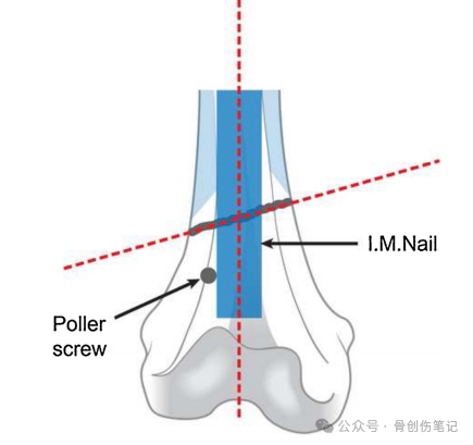 How to Precisely Place Poller (Blocking) Screws?