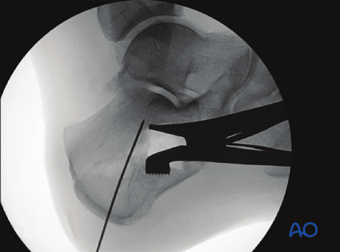 Minimally Invasive K‑Wire and Screw Fixation for Calcaneal Fractures