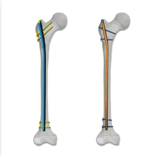 Pediatric femoral intramedullary nail: a fracture fixation technique designed specifically for children