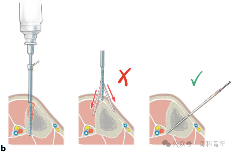Surgical Steps