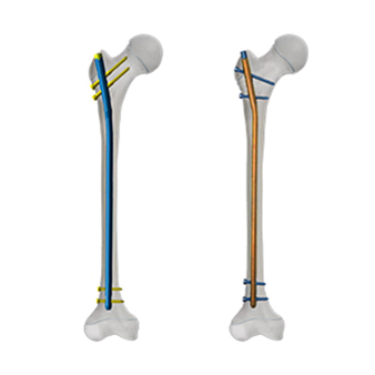 Femoral Bone Marrow Nail in Children